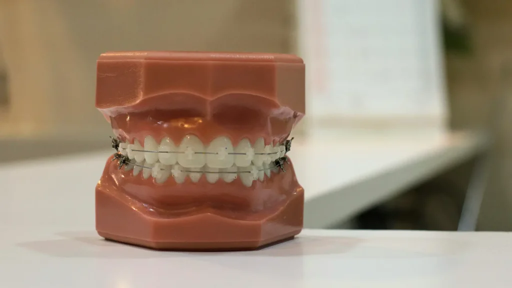 Aparelhos Dentários Aparelhos Dentários