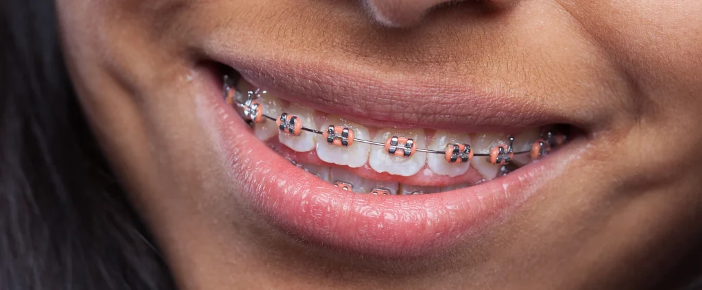 Aparelhos Dentários - Ortodontia