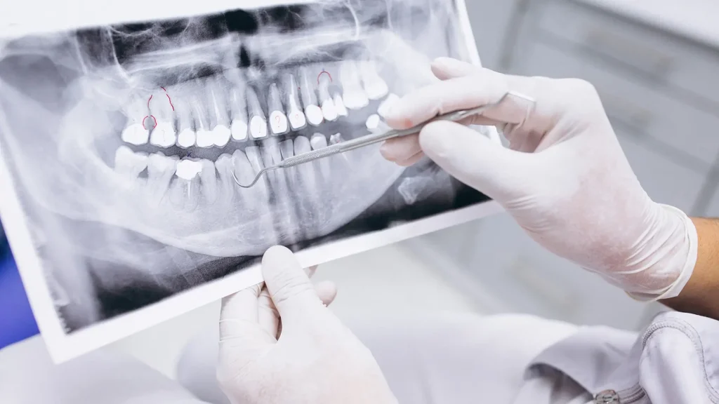 Avaliação Endodontia Avaliação Endodontia