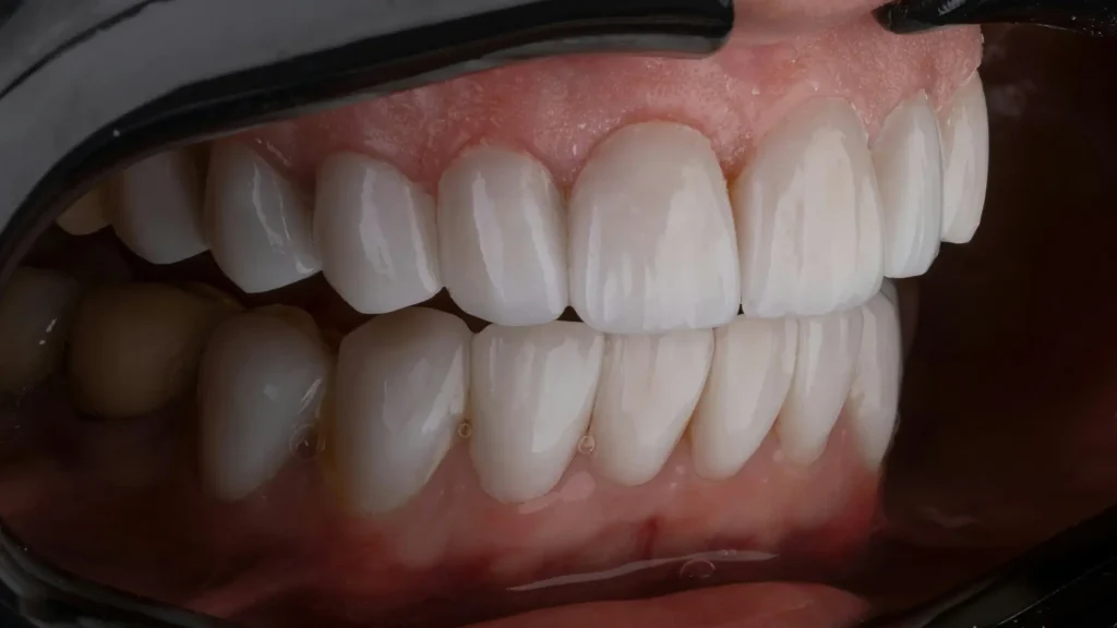 Facetas Aplicadas Facetas Aplicadas