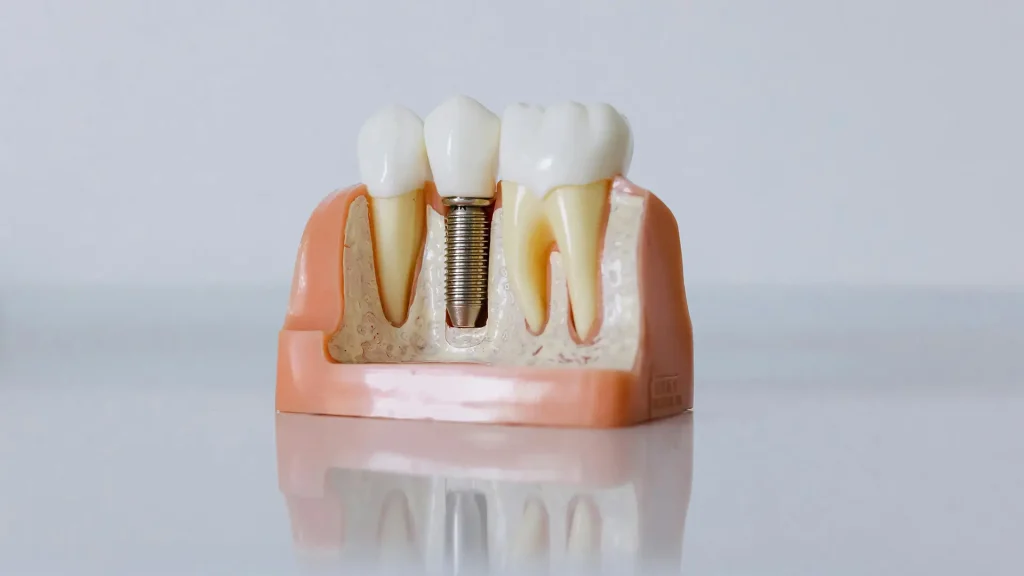 Implantes Dentários Implantes Dentários