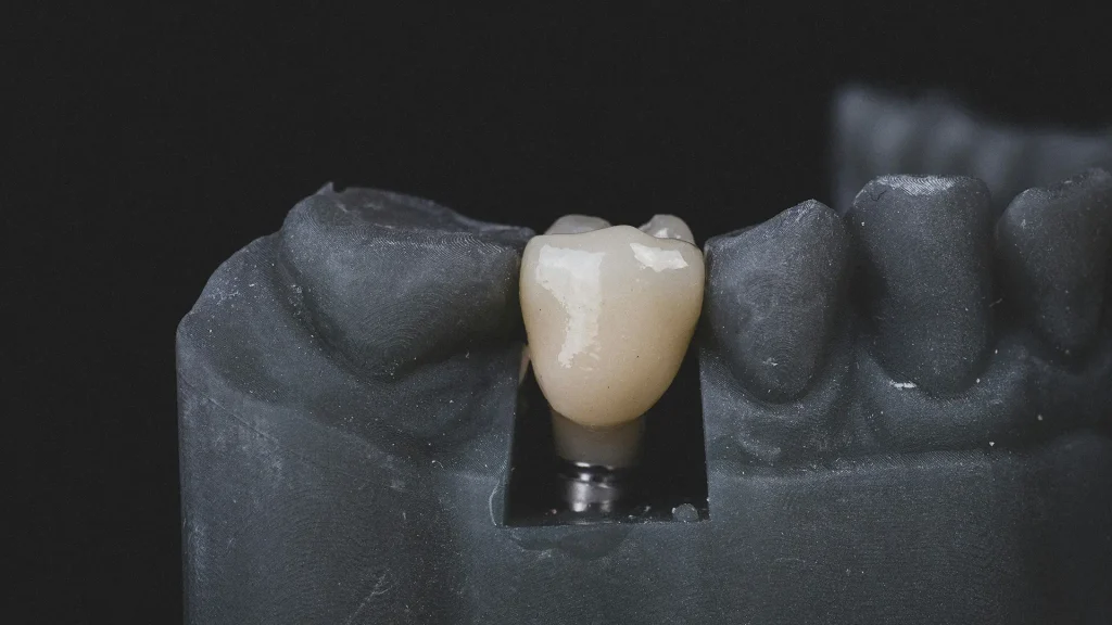 Implantologia Dente Implantologia Dente