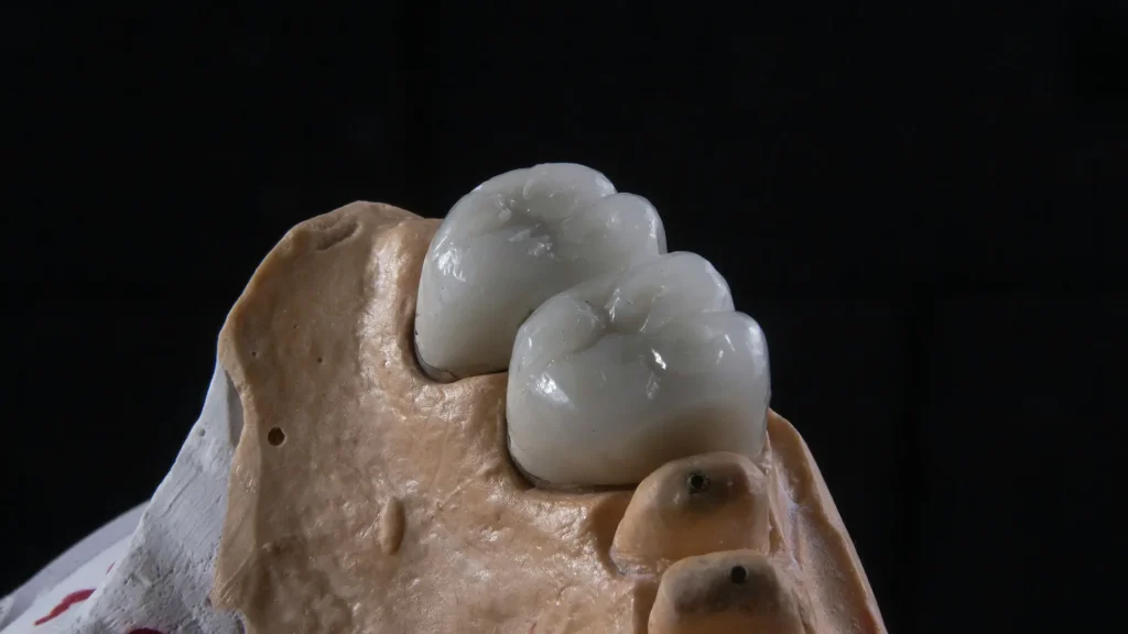 Implantologia Testes Implantologia Testes