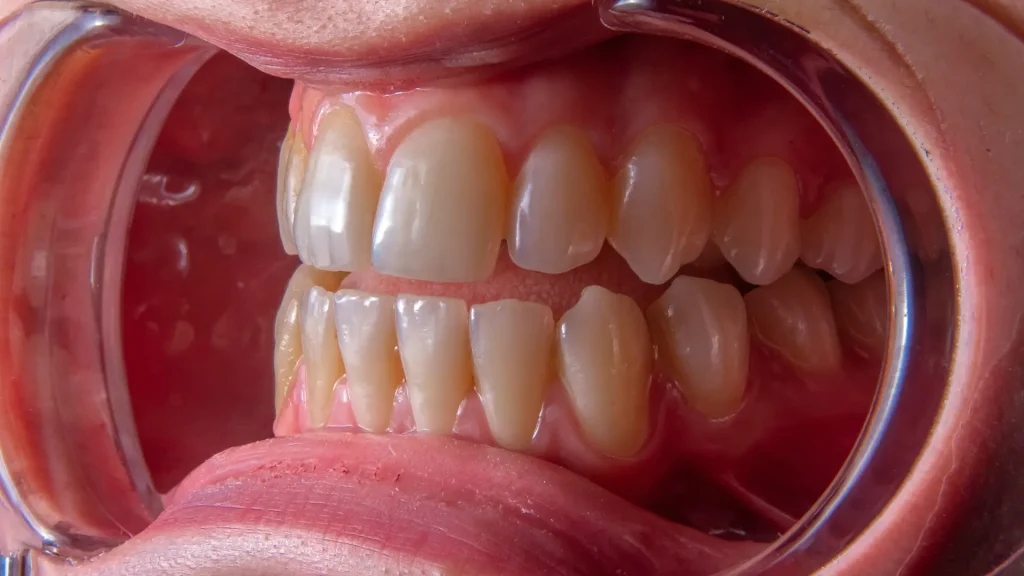 Periodontite Gengivas Periodontite Gengivas