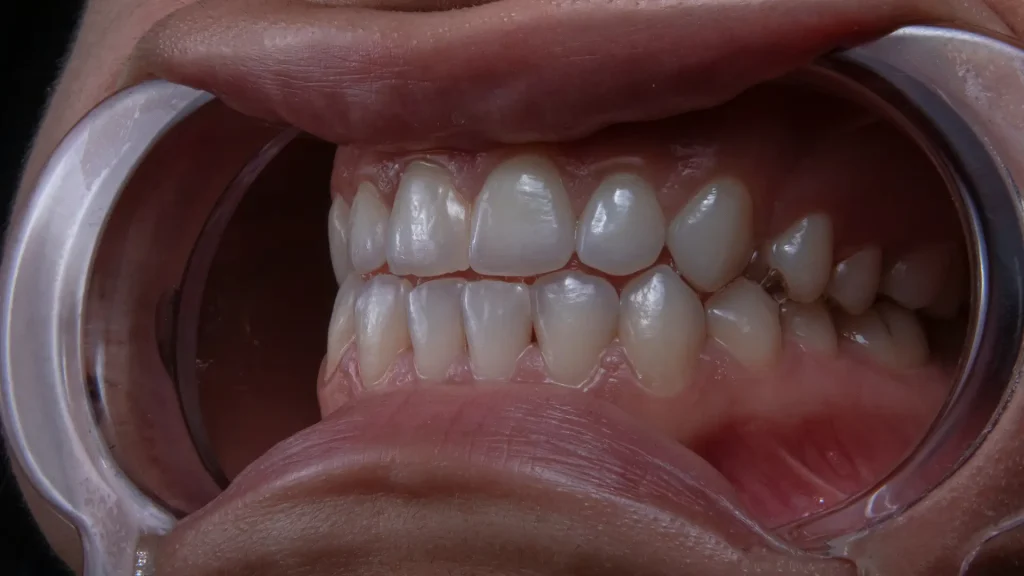 Sorriso com Facetas Dentárias Sorriso com Facetas Dentárias