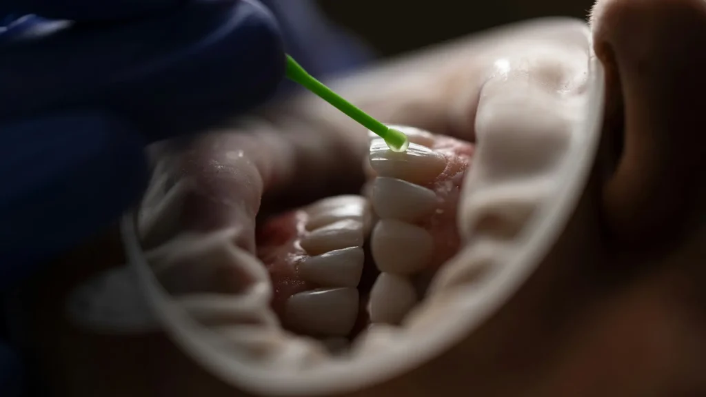 Tratamento Facetas Dentárias Tratamento Facetas Dentárias