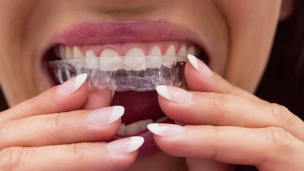 Colocar Invisalign
